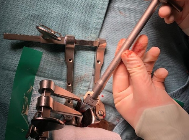 Lekarze z USK w Opolu wszczepili ruchomą protezę dysku szyjnego Moove-C. To pierwszy zabieg w kraju i trzeci na świecie