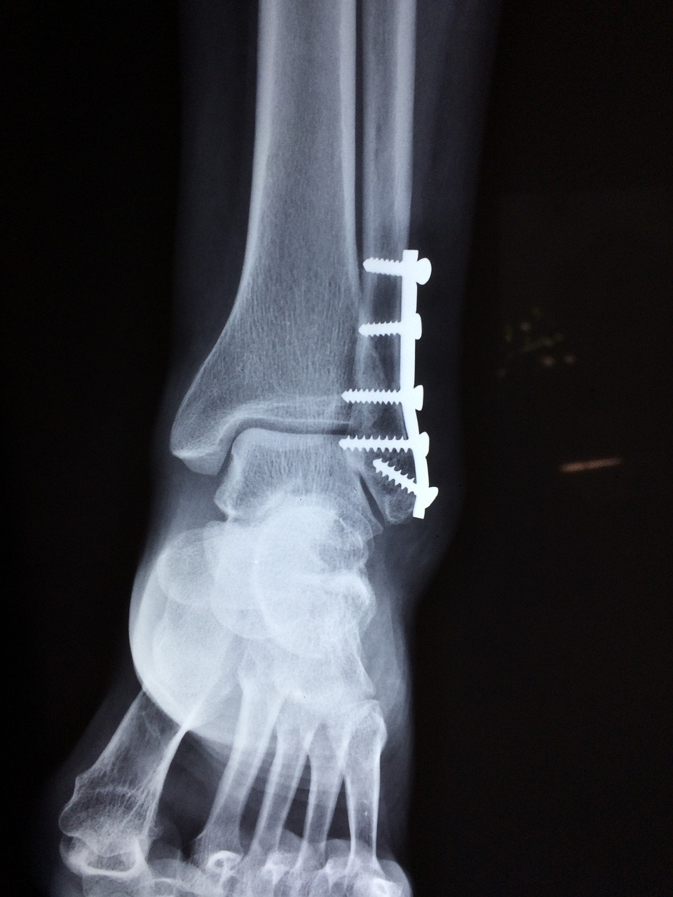 zdjęcie poglądowe, złamana noga, rentgen, [fot. pixabay.com]